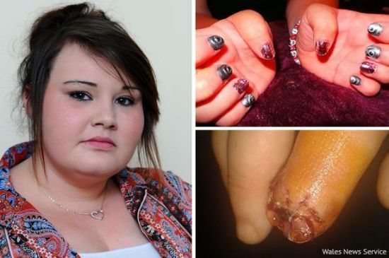 英少女用劣质指甲油致手指腐烂遭截肢 英少女用劣质指甲油致手指腐烂遭截肢